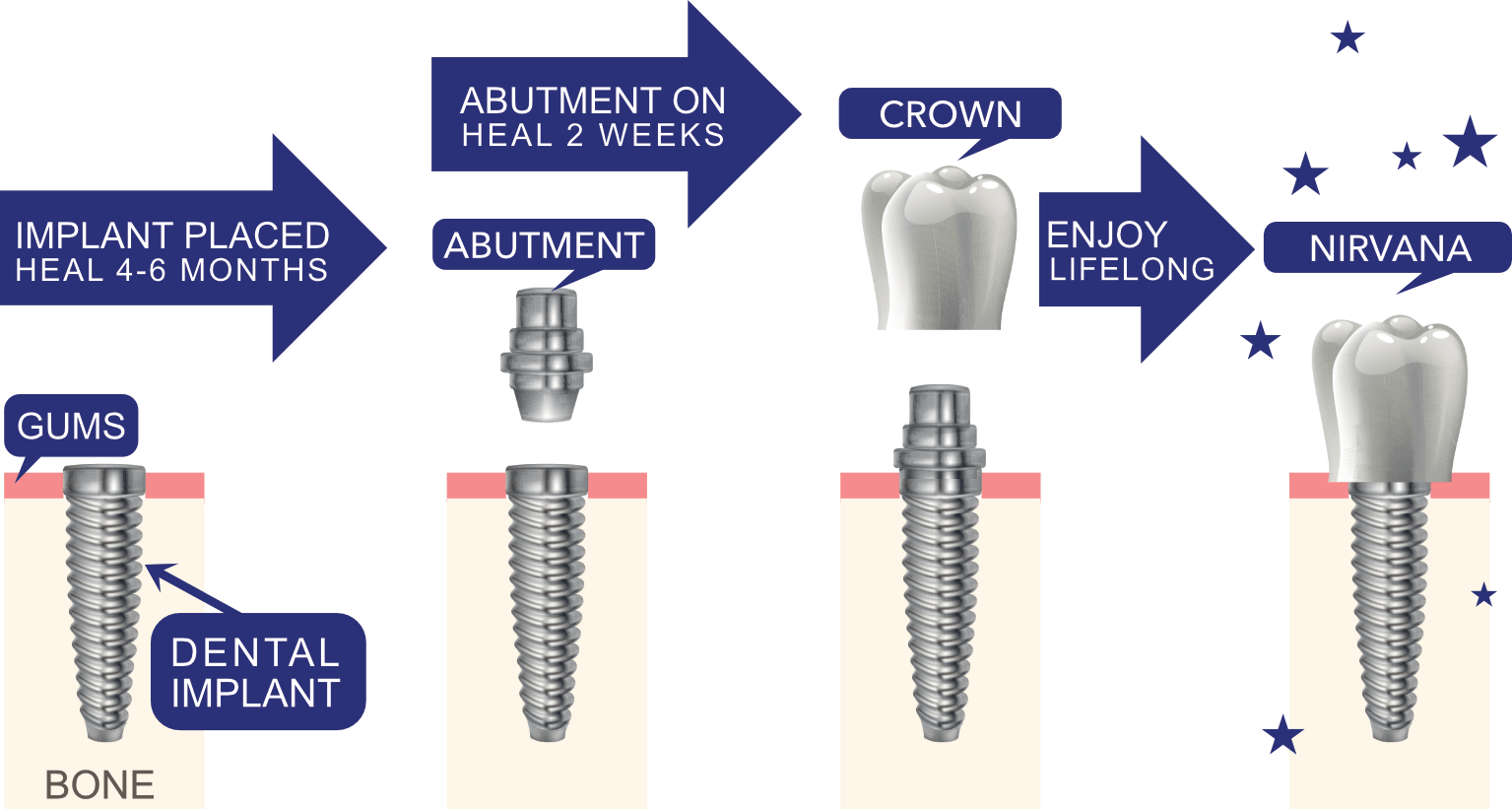 dental implant treatment