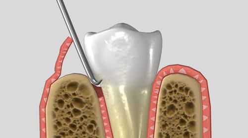 Flap Surgery